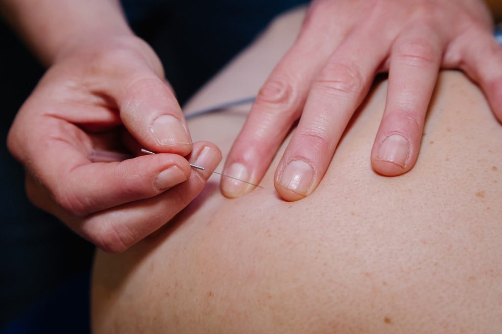 Patiënt wordt geprikt met dry needling door de behandelend therapeut